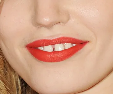 Watch this insane timelapse video of braces transforming teeth