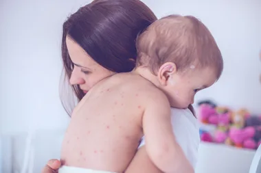 Chicken pox vaccine will be free for New Zealand children