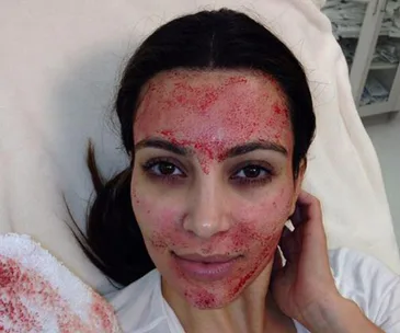 Watch what it’s like to get a vampire facial