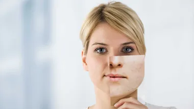 How to get rid of acne scars