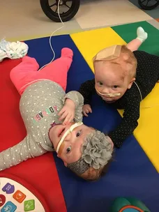 Australian baby twins conjoined at the head survive their separation surgery