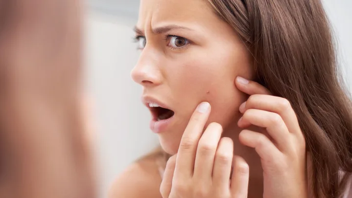 Squeeze pimple