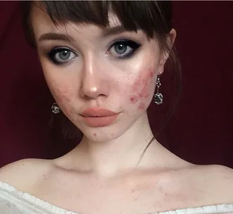 Girl shares her before and after acne photos to encourage others to have hope