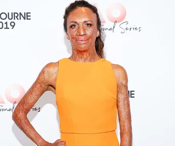 Burns survivor Turia Pitt reveals Australian bush fires have given her nightmares