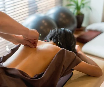 Woman getting acupuncture on back