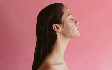 Profile of a person with acne on their cheek, against a pink background.