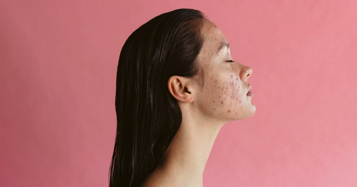 The best acne treatments for clearer, happier skin