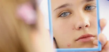 Acne ads cause heartache