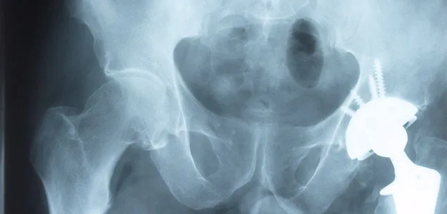 Diamond-coated hips are forever