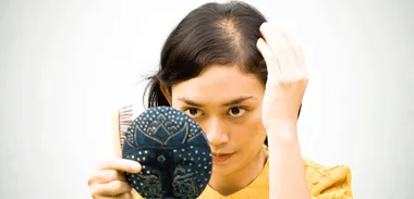 Alopecia Areata