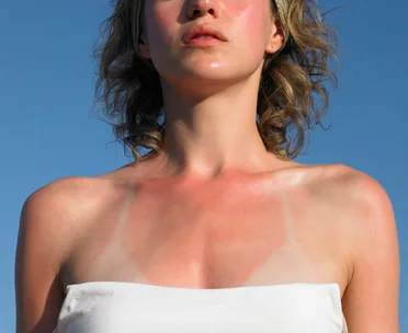 Red skin relief