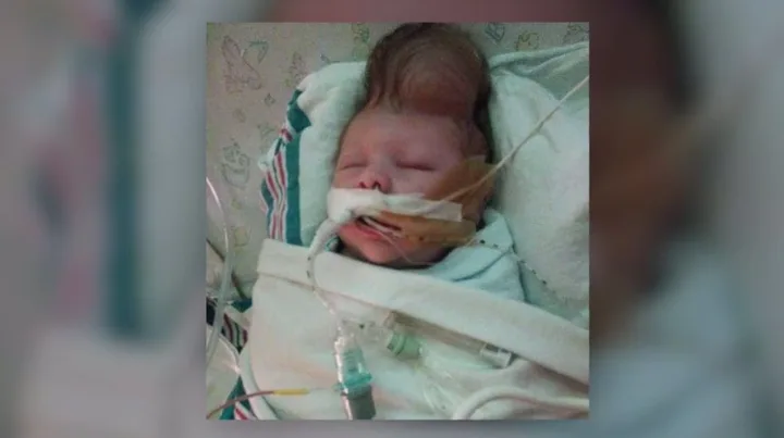baby born with brain outside skull