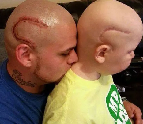 Dad gets cancer tattoo on head to match son